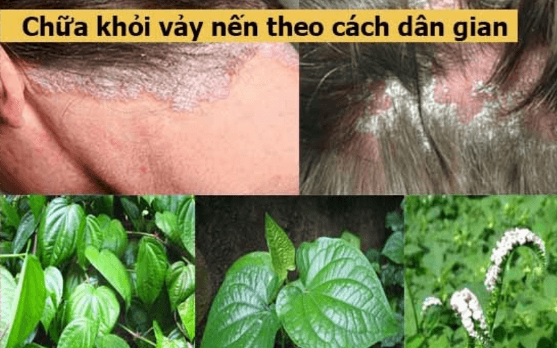 Cách chữa bệnh vảy nến da đầu