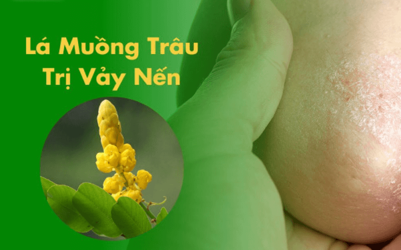 cây muồng trâu trị vảy nến