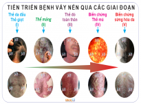 Bệnh vảy nến (Psoriasis) 